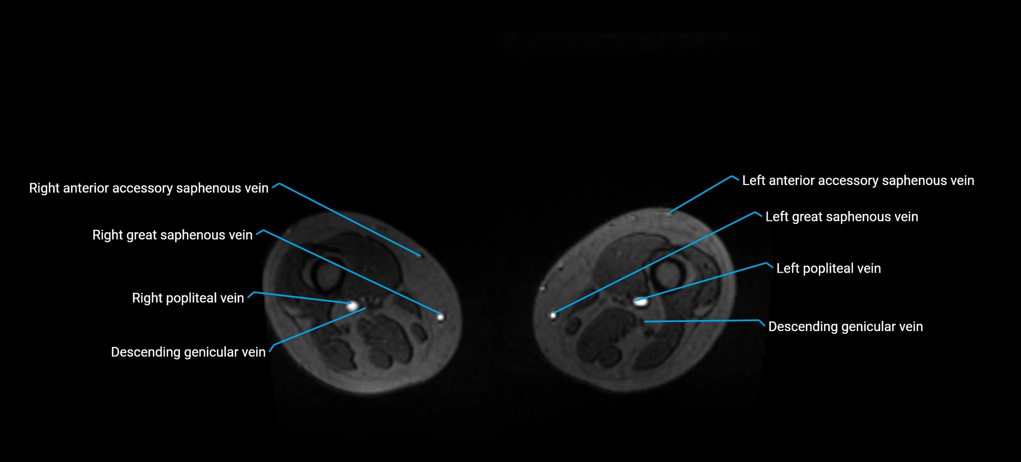 MRV abdomen pelvis & lower limb axial cross sectional anatomy labelled MRI image 318.webp